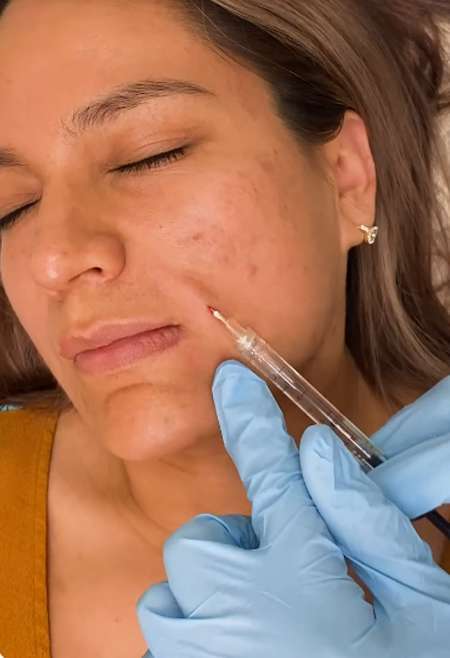 facial filler dermal filler