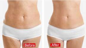 Accent Prime Body Shaping