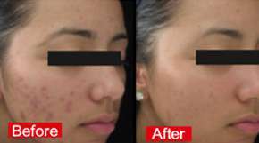 Acne & Acne Scars removal