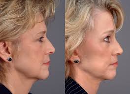 fat-grafting | face-lift-surgery