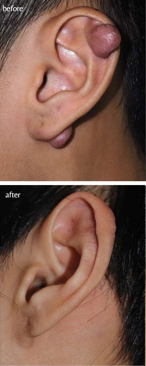 earlobe keloid removal